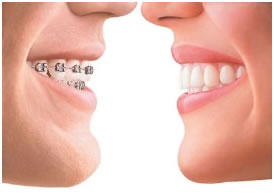 Invisable Braces Benefits